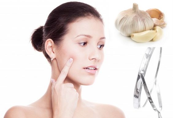 Last minute tips to get rid of pimples before your wedding day